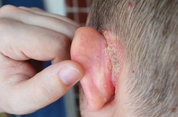 chàm vành tai ở trẻ sơ sinh